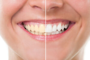 Why Do Teeth Turn Yellow